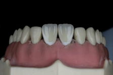 a model of a tooth with gums on it